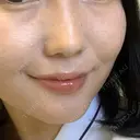 小鼻縮小（切開） / ヒアルロン酸注入（鼻） 東京形成美容外科 船橋院 DAY 100 サムネイル用