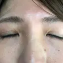 二重切開 / 眼瞼下垂（切開） / 上まぶたたるみ取り 湘南美容クリニック 高田馬場院 DAY 48 サムネイル用