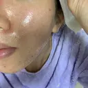 ニキビ治療 アサイクリニック 心斎橋本院 DAY 115 サムネイル用