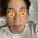 ダーマペン 表参道スキンクリニック 名古屋院（DAILY SKIN CLINIC提携院） DAY 0 サムネイル用