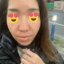 ダーマペン 表参道スキンクリニック 名古屋院（DAILY SKIN CLINIC提携院） DAY 0 サムネイル用