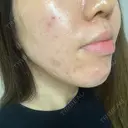 ニキビ治療 アサイクリニック 心斎橋本院 DAY 154 サムネイル用