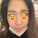 ヒアルロン酸注入（こめかみ） 湘南美容クリニック 京都院 AFTER サムネイル用