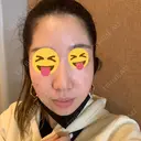 ヒアルロン酸注入（こめかみ） 湘南美容クリニック 京都院 DAY 0 サムネイル用