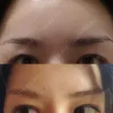 眉下切開 エイペックス美容外科 DAY 59 サムネイル用