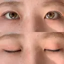 二重埋没 R.O.clinic DAY 98 サムネイル用