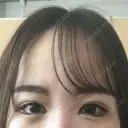 目尻切開 / タレ目形成・グラマラスライン（切開） B-LINE CLINIC 池袋院 DAY 11 サムネイル用