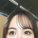 目尻切開 / タレ目形成・グラマラスライン（切開） B-LINE CLINIC 池袋院 AFTER サムネイル用