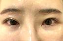 二重切開 / 眼瞼下垂（切開） / クマ治療 / 上まぶたたるみ取り / 眉下切開 くさのたろうクリニック DAY 25 サムネイル用