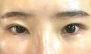 二重切開 / 眼瞼下垂（切開） / クマ治療 / 上まぶたたるみ取り / 眉下切開 くさのたろうクリニック DAY 26 サムネイル用