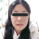 骨切り（あご） / 骨削り（頬） / ルフォー+ssro（両あご) リラ・クラニオフェイシャル・クリニック DAY 60 サムネイル用