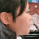 骨切り（あご） / 骨削り（頬） / ルフォー+ssro（両あご) リラ・クラニオフェイシャル・クリニック DAY 60 サムネイル用