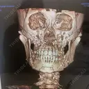 骨切り（あご） / 骨削り（頬） / ルフォー+ssro（両あご) リラ・クラニオフェイシャル・クリニック DAY 90 サムネイル用