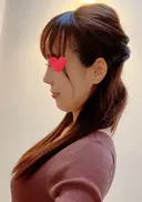 鼻尖形成（切開） / 鼻中隔延長（切開） / 軟骨移植 / ワシ鼻修正・ハンプ切除 / 真皮移植 湘南美容クリニック 上野院 DAY 18 サムネイル用