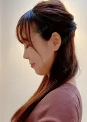 鼻尖形成（切開） / 鼻中隔延長（切開） / 軟骨移植 / ワシ鼻修正・ハンプ切除 / 真皮移植 湘南美容クリニック 上野院 DAY 18 サムネイル用