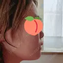 骨切り（あご） / 骨削り（頬） / ルフォー+ssro（両あご) リラ・クラニオフェイシャル・クリニック DAY 159 サムネイル用