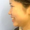 ボトックス（エラ・小顔） / 脂肪溶解注射（顔） 湘南美容クリニック 宇都宮院 DAY 0 サムネイル用