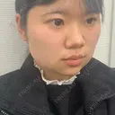 ボトックス（エラ・小顔） / 脂肪溶解注射（顔） 湘南美容クリニック 宇都宮院 DAY 0 サムネイル用