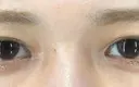 蒙古ひだ形成 R.O.clinic DAY 88 サムネイル用