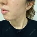 ニキビ治療 アサイクリニック 心斎橋本院 DAY 164 サムネイル用