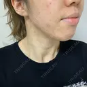 ニキビ治療 アサイクリニック 心斎橋本院 DAY 164 サムネイル用