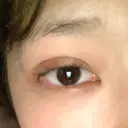 二重埋没 R Beauty CLINIC 銀座院 DAY 3 サムネイル用