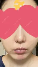 小鼻縮小（切開） / 鼻翼基部形成（貴族手術） 新宿ラクル美容外科クリニック 新宿院 DAY 29 サムネイル用