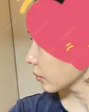 小鼻縮小（切開） / 鼻翼基部形成（貴族手術） 新宿ラクル美容外科クリニック 新宿院 DAY 29 サムネイル用
