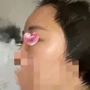 額を丸く / 脂肪注入（肌） / 脂肪注入（額） ヴェルトラクリニック 大阪院 DAY 4 サムネイル用