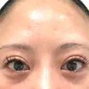 二重切開 BIANCA銀座 AFTER サムネイル用