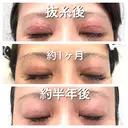 二重切開 BIANCA銀座 DAY 187 サムネイル用