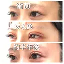 二重切開 BIANCA銀座 DAY 187 サムネイル用