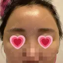 額を丸く / 脂肪注入（肌） / 脂肪注入（額） ヴェルトラクリニック 大阪院 DAY 6 サムネイル用