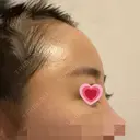 額を丸く / 脂肪注入（肌） / 脂肪注入（額） ヴェルトラクリニック 大阪院 DAY 6 サムネイル用