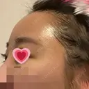 額を丸く / 脂肪注入（肌） / 脂肪注入（額） ヴェルトラクリニック 大阪院 DAY 6 サムネイル用