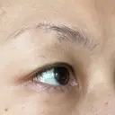 眼瞼下垂（切開） 湘南美容クリニック 秋葉原院 DAY 44 サムネイル用