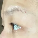 眼瞼下垂（切開） 湘南美容クリニック 秋葉原院 DAY 44 サムネイル用