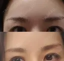 眉下切開 エイペックス美容外科 AFTER サムネイル用