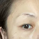 目尻切開 湘南美容クリニック 秋葉原院 AFTER サムネイル用