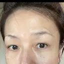 目尻切開 湘南美容クリニック 秋葉原院 DAY 86 サムネイル用