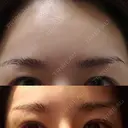 眉下切開 エイペックス美容外科 DAY 41 サムネイル用