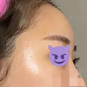 額を丸く / 脂肪注入（肌） / 脂肪注入（額） ヴェルトラクリニック 大阪院 DAY 7 サムネイル用