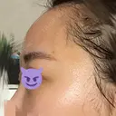 額を丸く / 脂肪注入（肌） / 脂肪注入（額） ヴェルトラクリニック 大阪院 DAY 7 サムネイル用