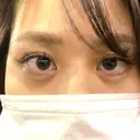 ヒアルロン酸注入（涙袋） フィラークリニック 新宿院 DAY 0 サムネイル用