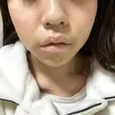 ヒアルロン酸注入（涙袋） フィラークリニック 新宿院 DAY 0 サムネイル用