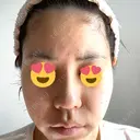 ヒアルロン酸注入（鼻） アクトリー勝どきウェルネスメディカルクリニック DAY 2 サムネイル用