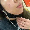 ニキビ治療 アサイクリニック 心斎橋本院 DAY 172 サムネイル用