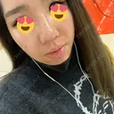 ピーリング（ニキビ・毛穴） / ダーマペン TRUE DESIGN CLINIC DAY 2 サムネイル用