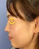 鼻尖形成（切開） / 鼻中隔延長（切開） / 軟骨移植 / ワシ鼻修正・ハンプ切除 / 真皮移植 湘南美容クリニック 上野院 DAY 31 サムネイル用