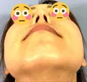 鼻尖形成（切開） / 鼻中隔延長（切開） / 軟骨移植 / ワシ鼻修正・ハンプ切除 / 真皮移植 湘南美容クリニック 上野院 DAY 31 サムネイル用